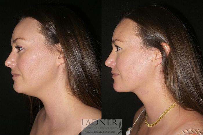 Minimally Invasive Neck Tightening Case 70 Before & After Left Side | Denver, CO | Ladner Facial Plastic Surgery