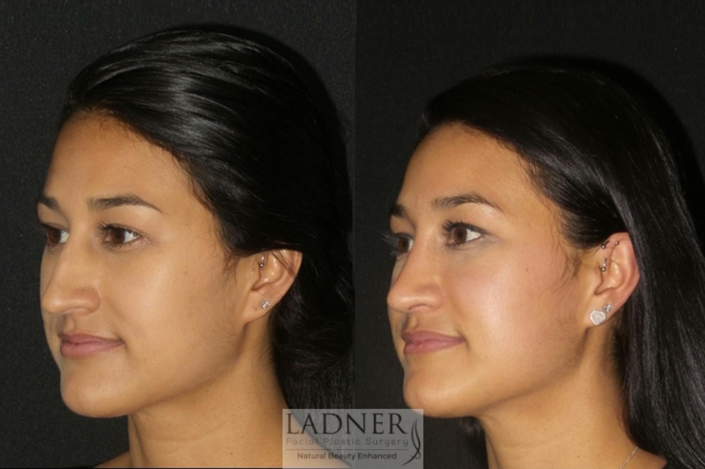Rhinoplasty Case 1 Before & After Left Oblique | Denver, CO | Ladner Facial Plastic Surgery