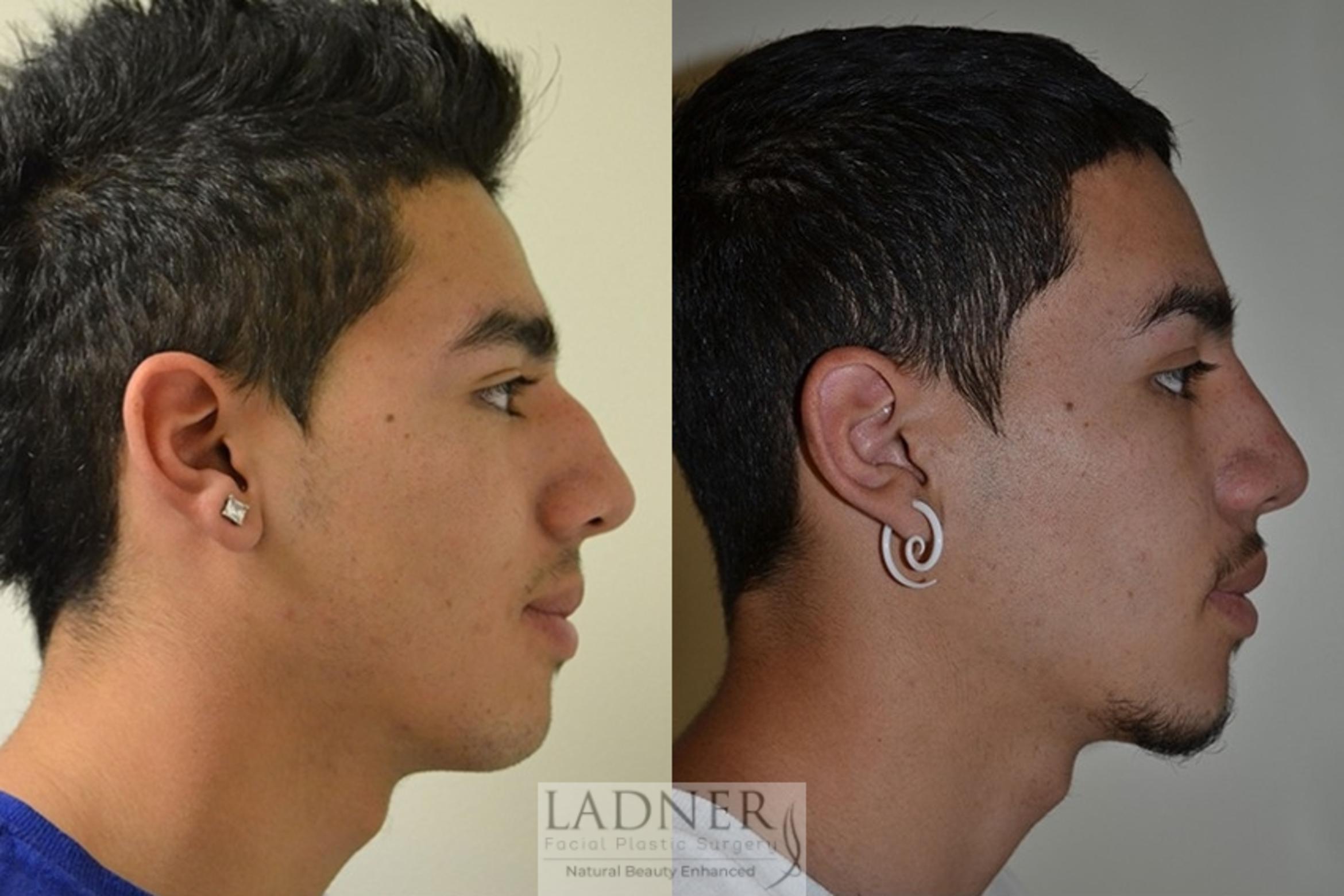 Rhinoplasty (Nose job) Case 12 Before & After Right Side | Denver, CO | Ladner Facial Plastic Surgery
