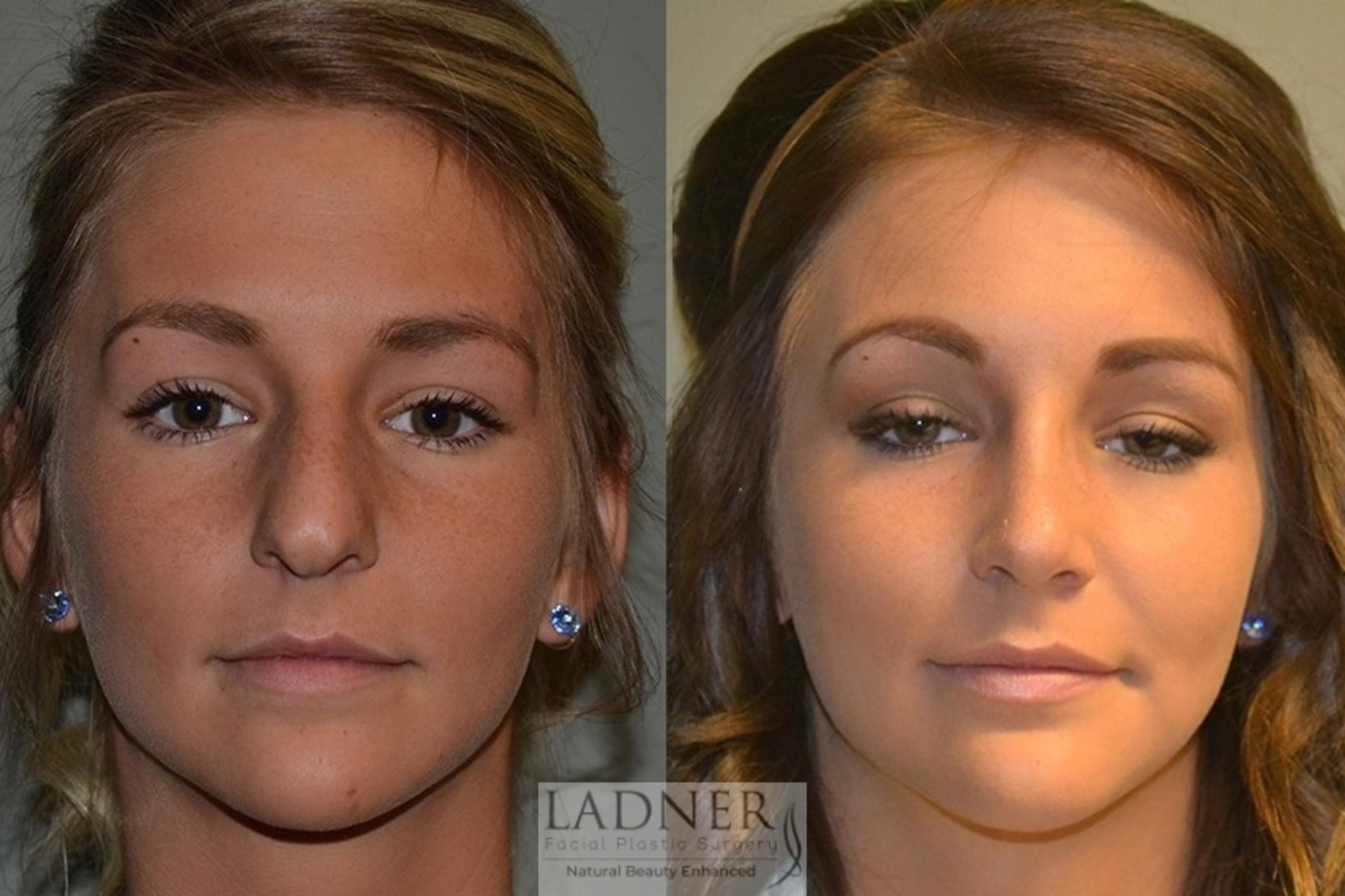 Rhinoplasty (Nose job) Case 15 Before & After Front | Denver, CO | Ladner Facial Plastic Surgery