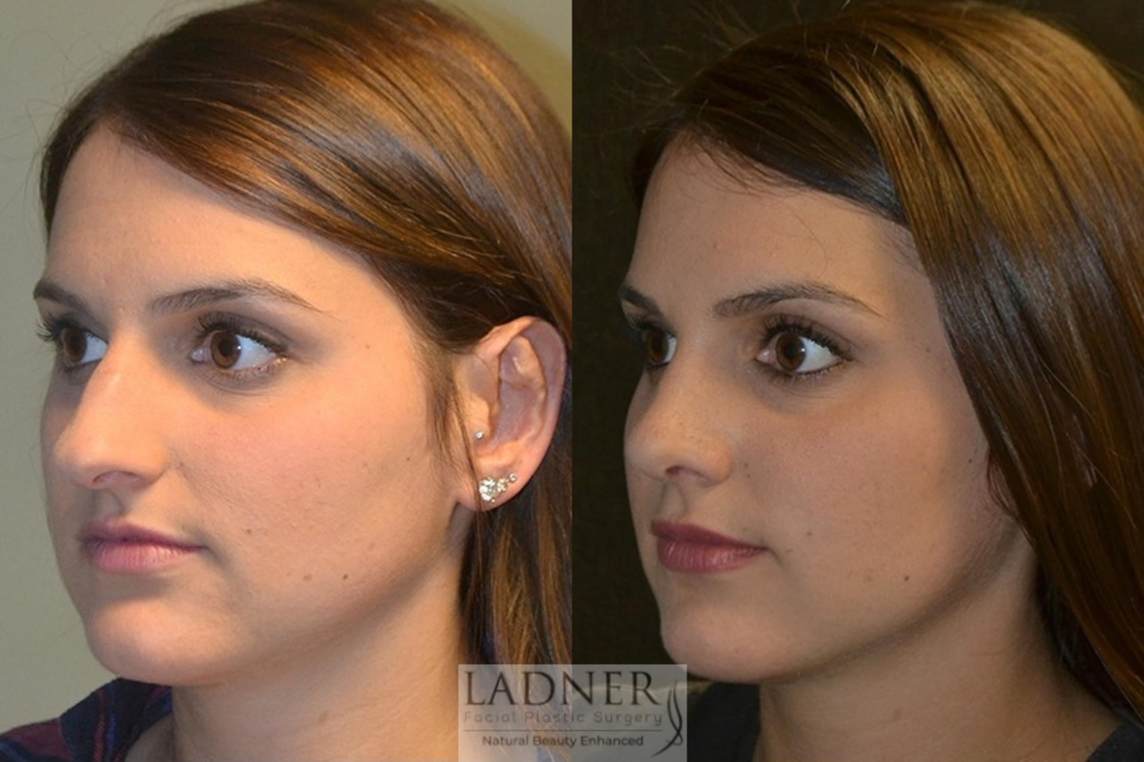 Rhinoplasty (Nose job) Case 16 Before & After Left Oblique | Denver, CO | Ladner Facial Plastic Surgery