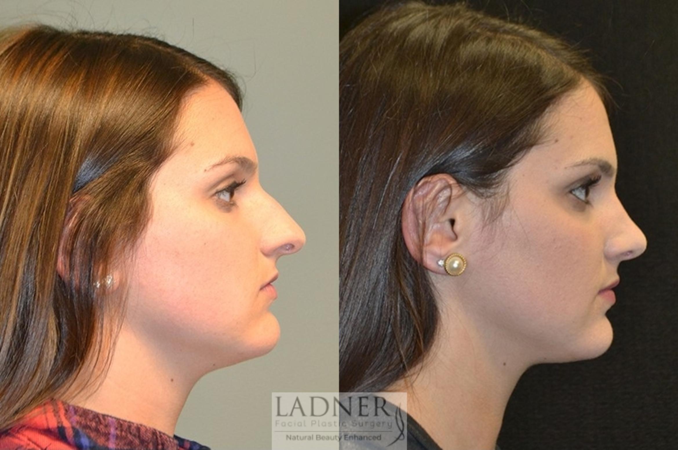 Rhinoplasty (Nose job) Case 16 Before & After Right Side | Denver, CO | Ladner Facial Plastic Surgery