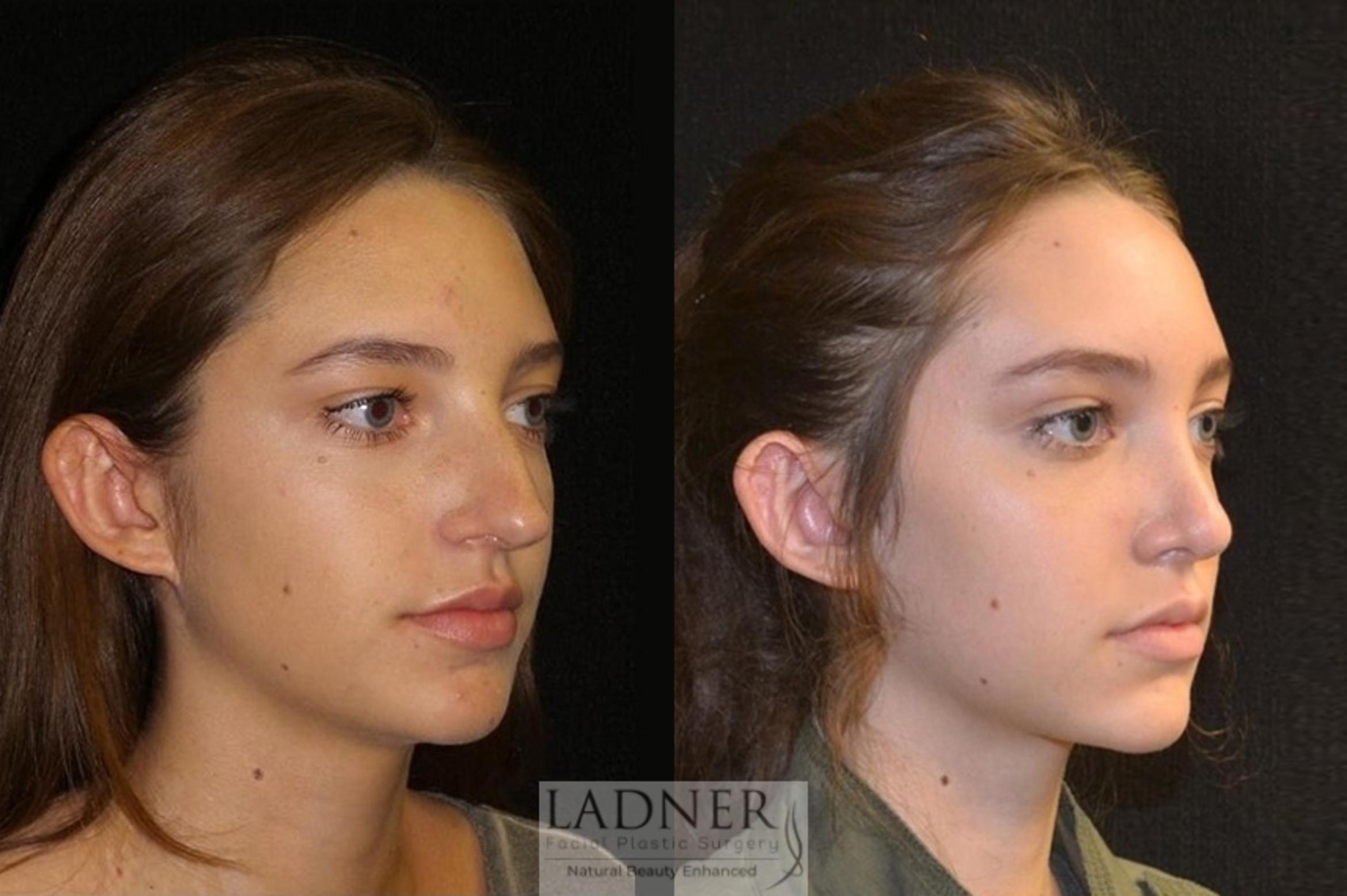 Rhinoplasty (Nose job) Case 19 Before & After Right Oblique | Denver, CO | Ladner Facial Plastic Surgery