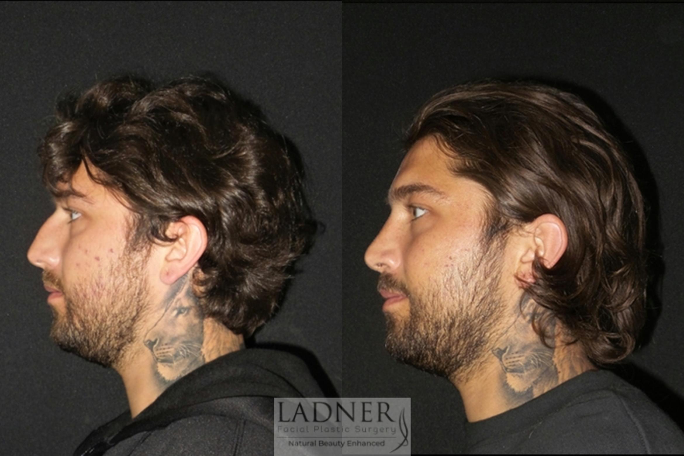 Facial Plastic Surgery for Men Case 4 Before & After Left Side | Denver, CO | Ladner Facial Plastic Surgery