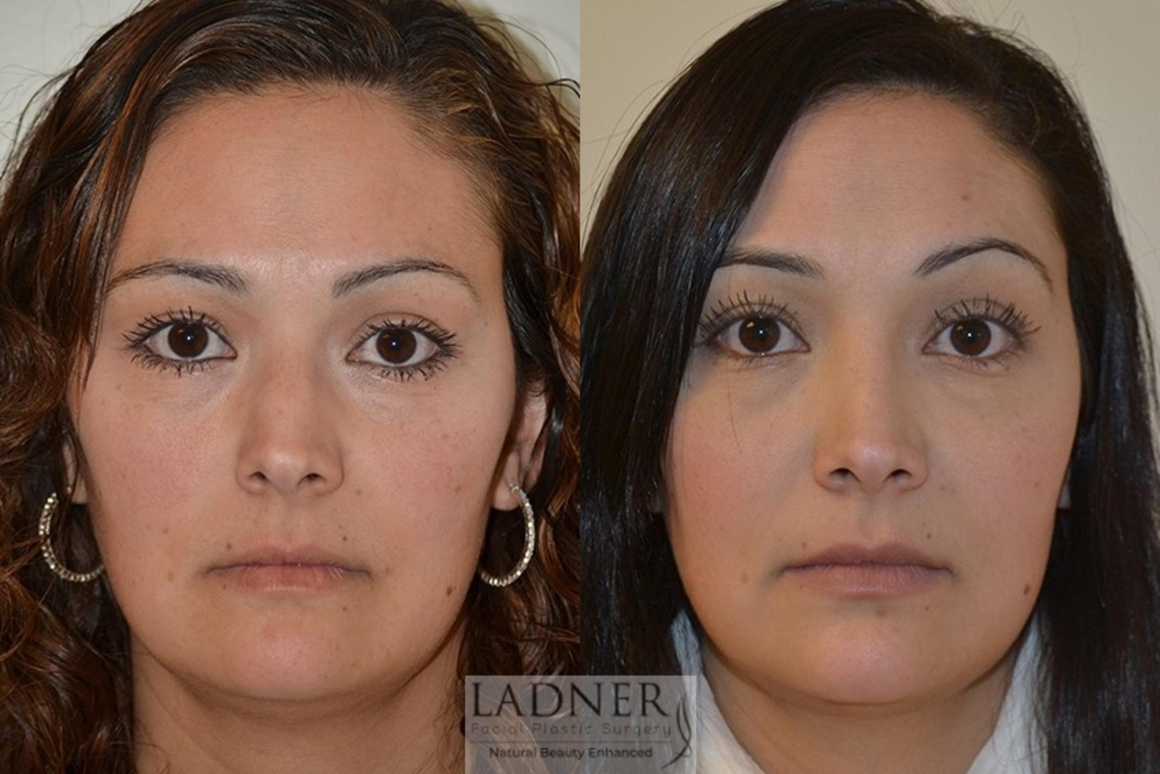 Rhinoplasty (Nose job) Case 42 Before & After Front | Denver, CO | Ladner Facial Plastic Surgery