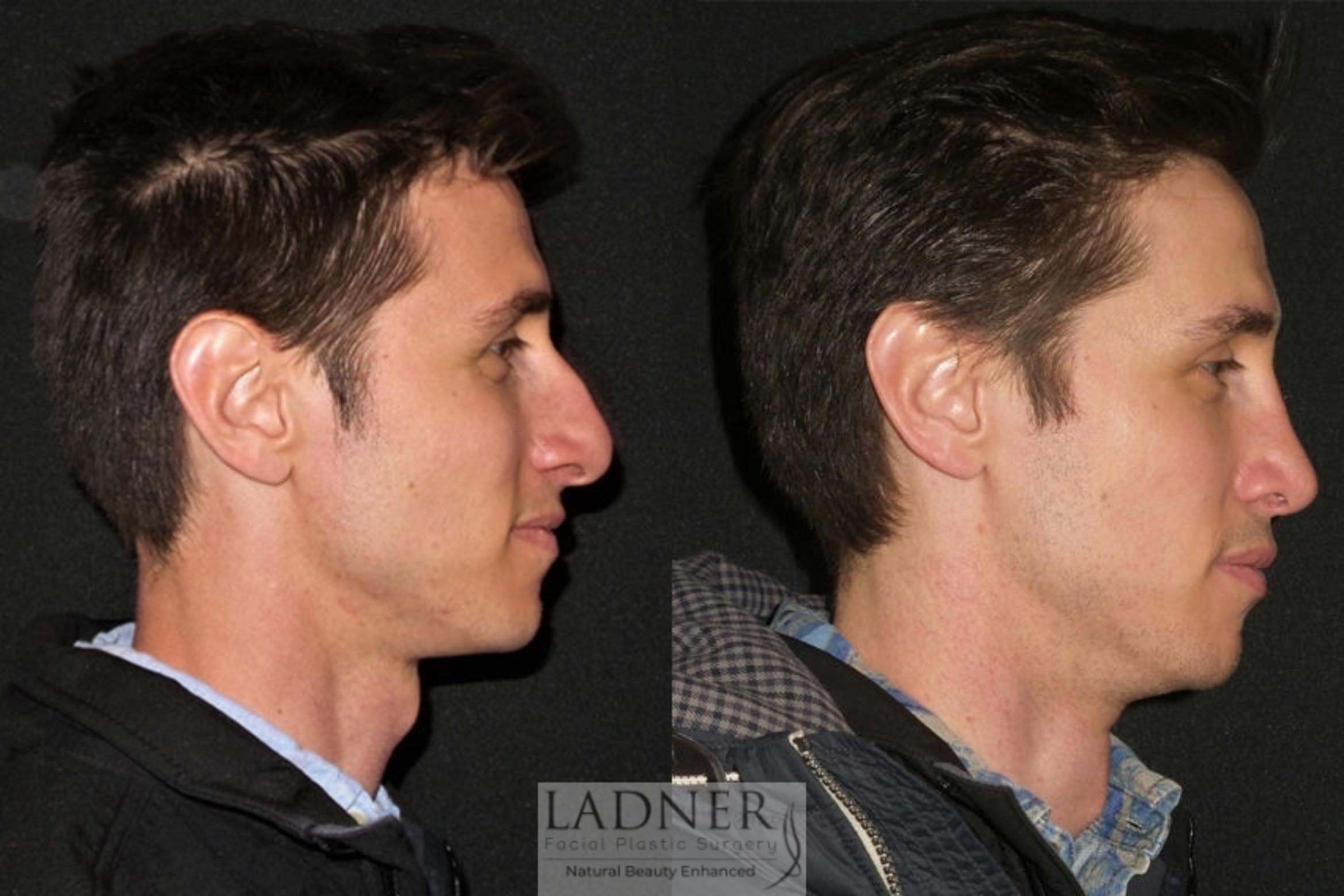Rhinoplasty Case 44 Before & After Right Side | Denver, CO | Ladner Facial Plastic Surgery