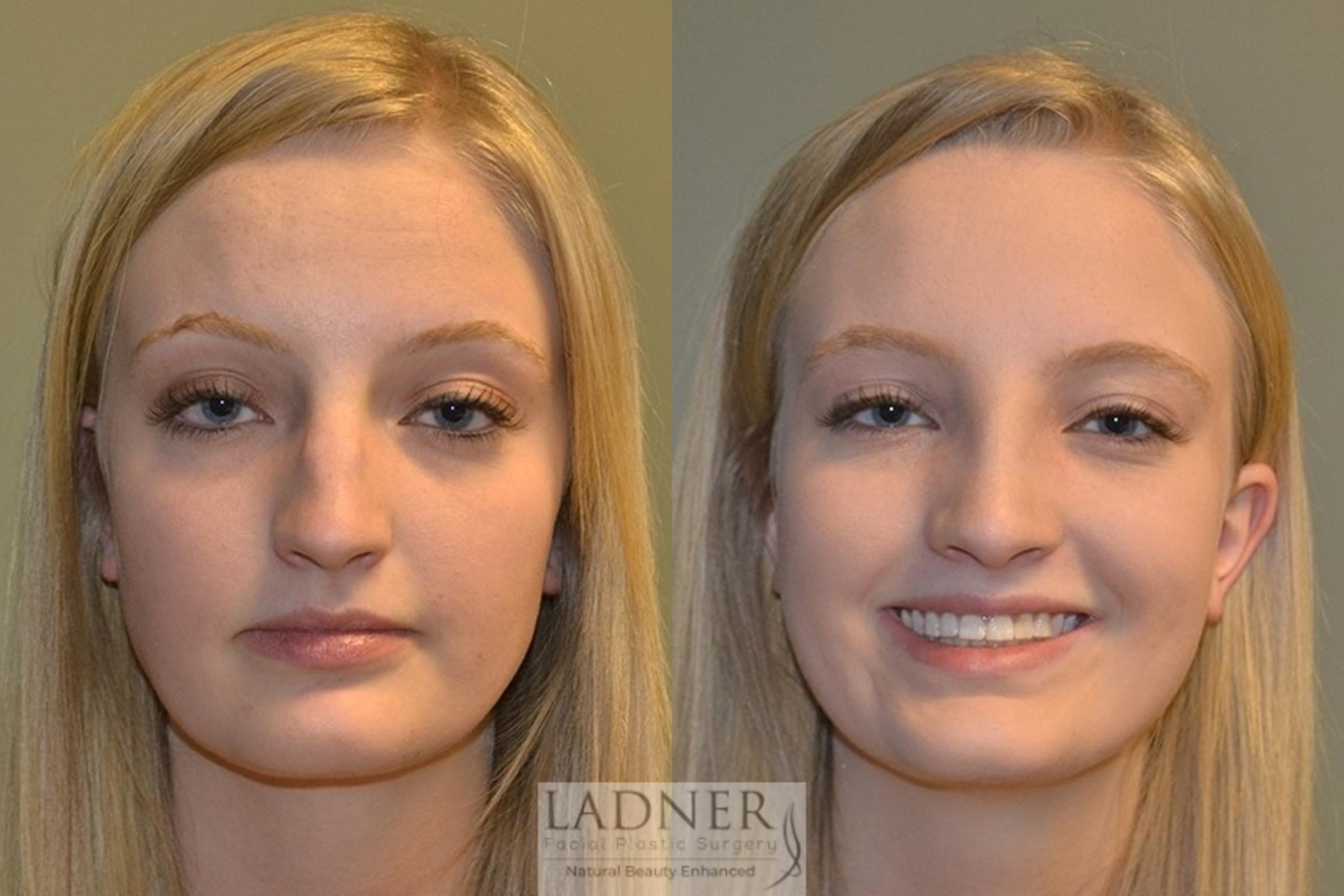 Rhinoplasty (Nose job) Case 45 Before & After Front | Denver, CO | Ladner Facial Plastic Surgery