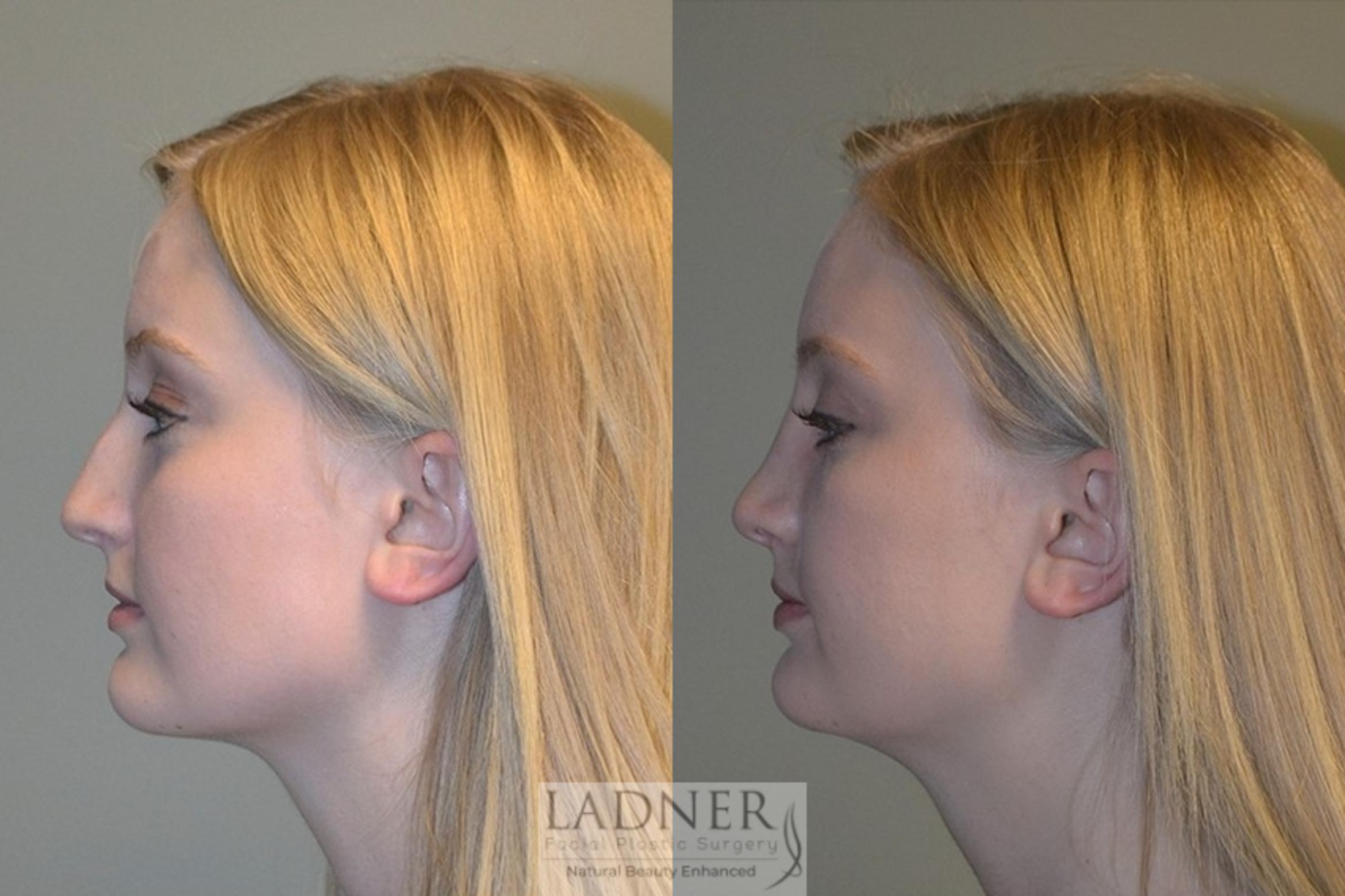 Rhinoplasty (Nose job) Case 45 Before & After Left Side | Denver, CO | Ladner Facial Plastic Surgery