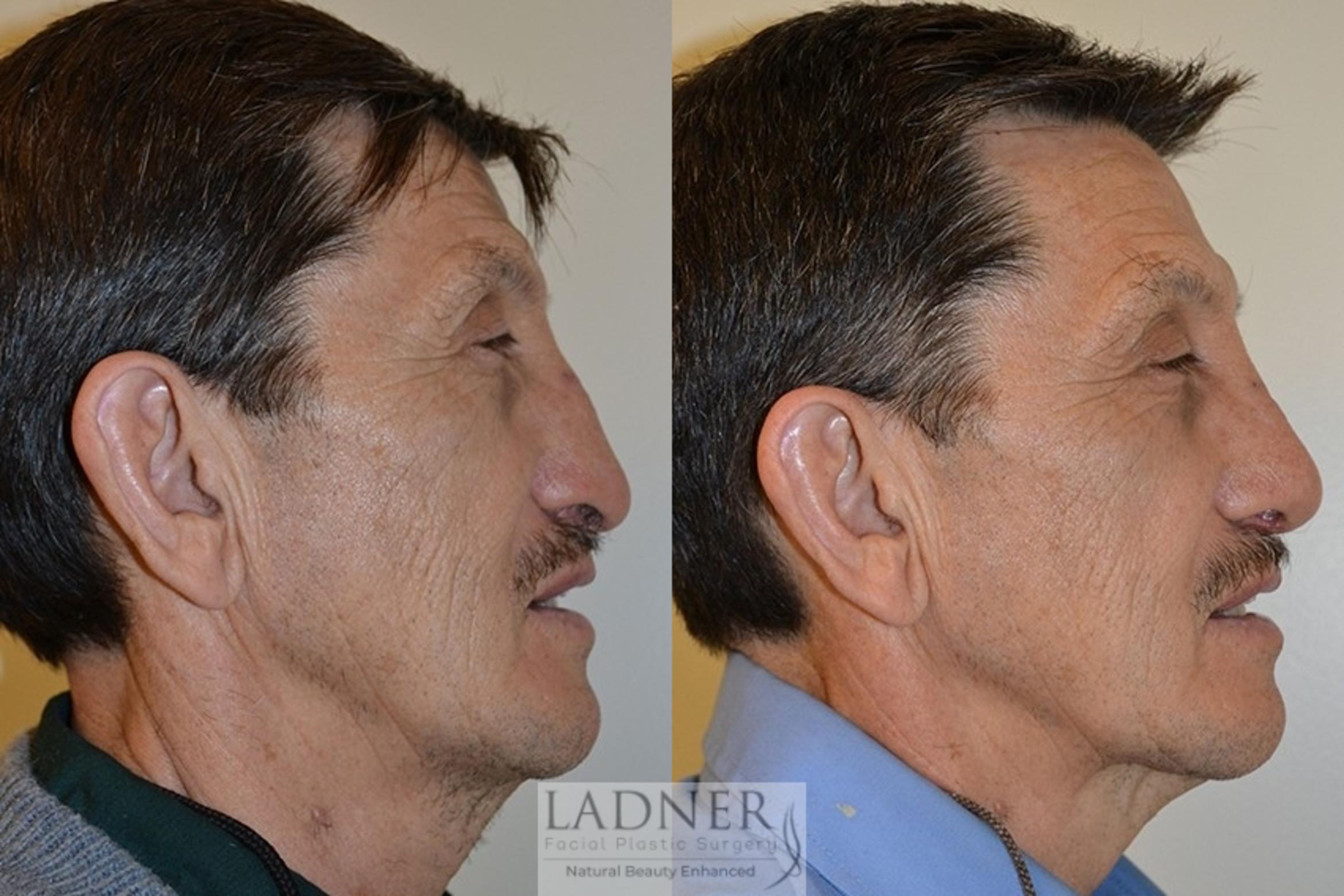 Facial Plastic Surgery for Men Case 46 Before & After Right Side | Denver, CO | Ladner Facial Plastic Surgery