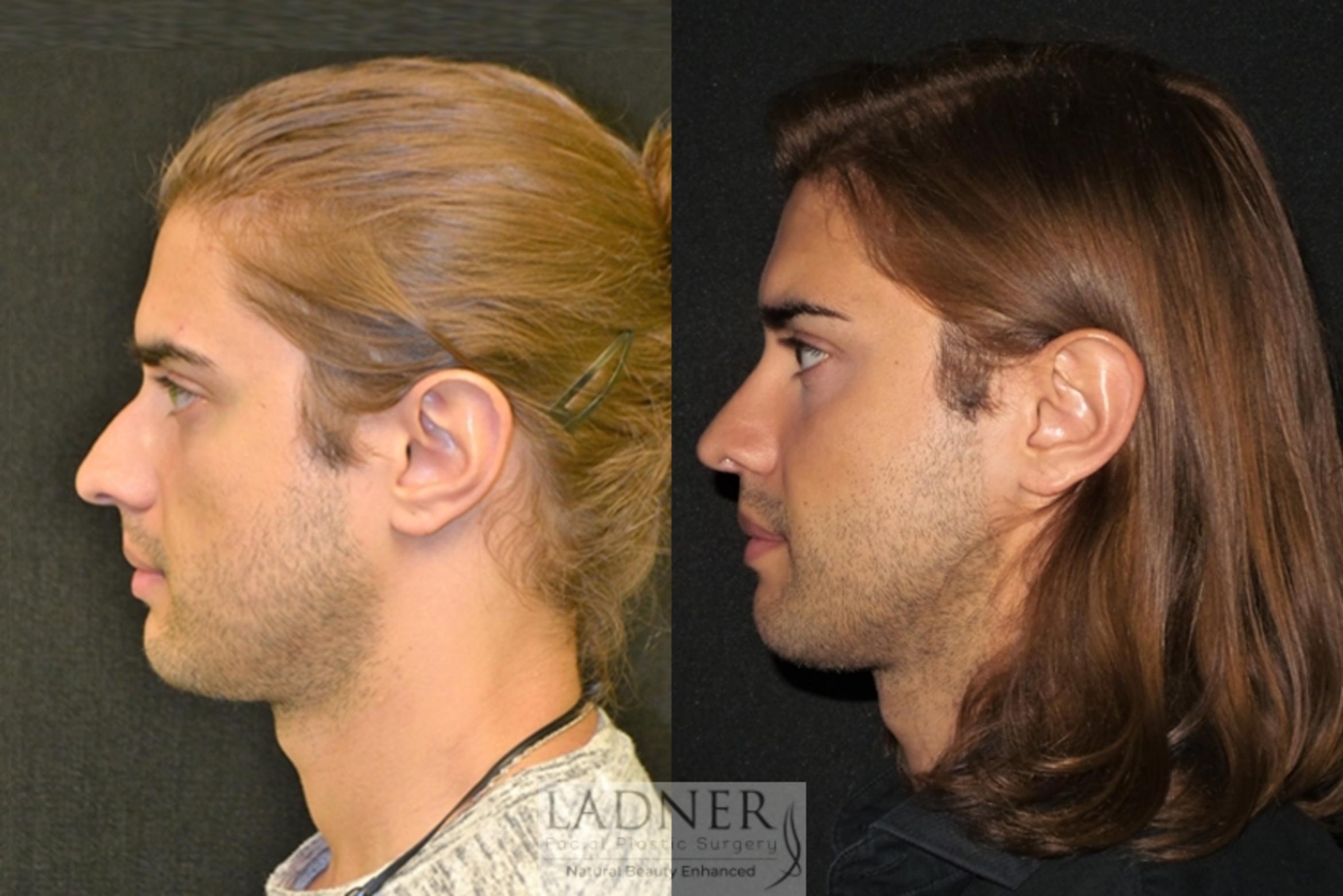 Facial Plastic Surgery for Men Case 5 Before & After Left Side | Denver, CO | Ladner Facial Plastic Surgery