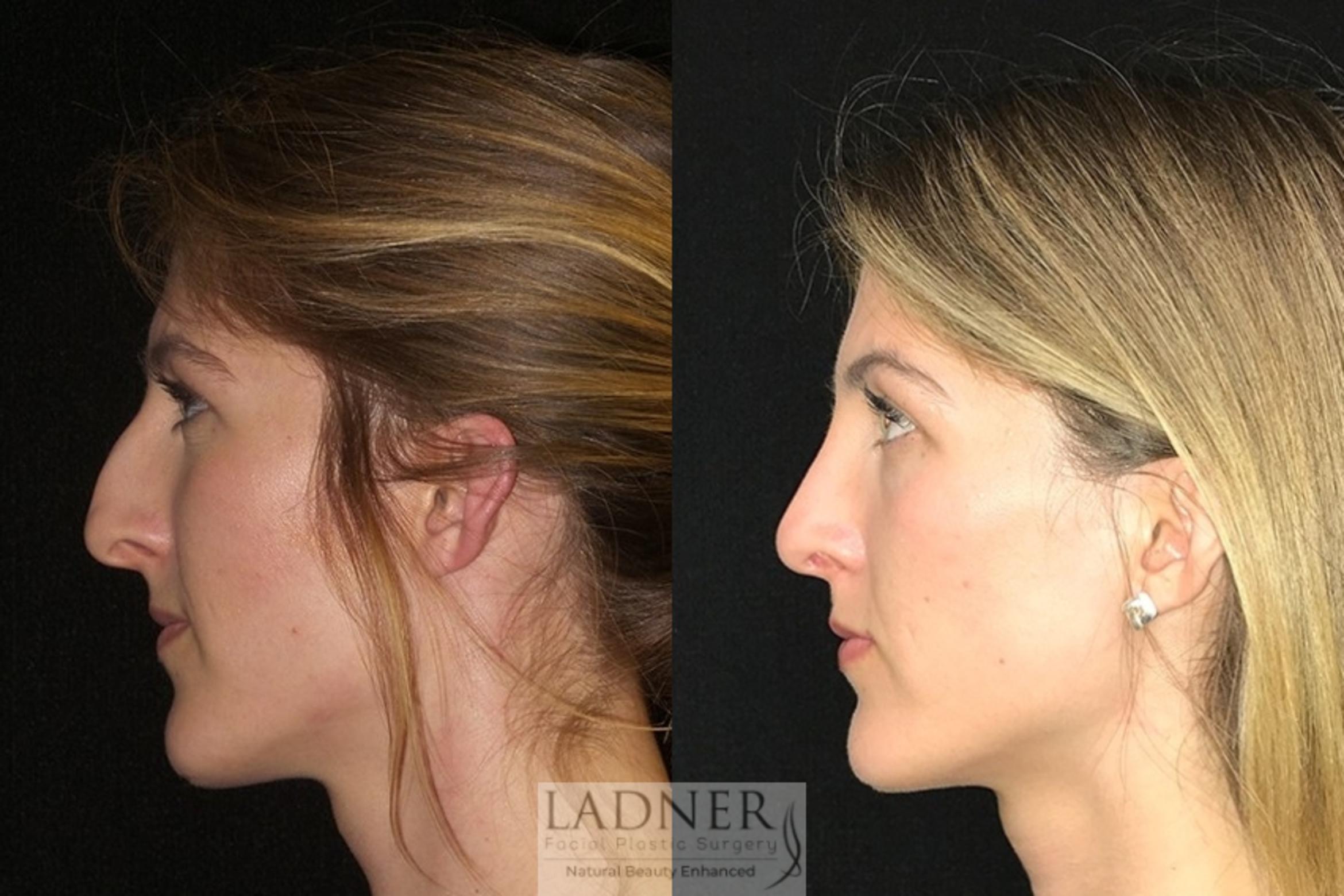 Rhinoplasty (Nose job) Case 8 Before & After Left Side | Denver, CO | Ladner Facial Plastic Surgery