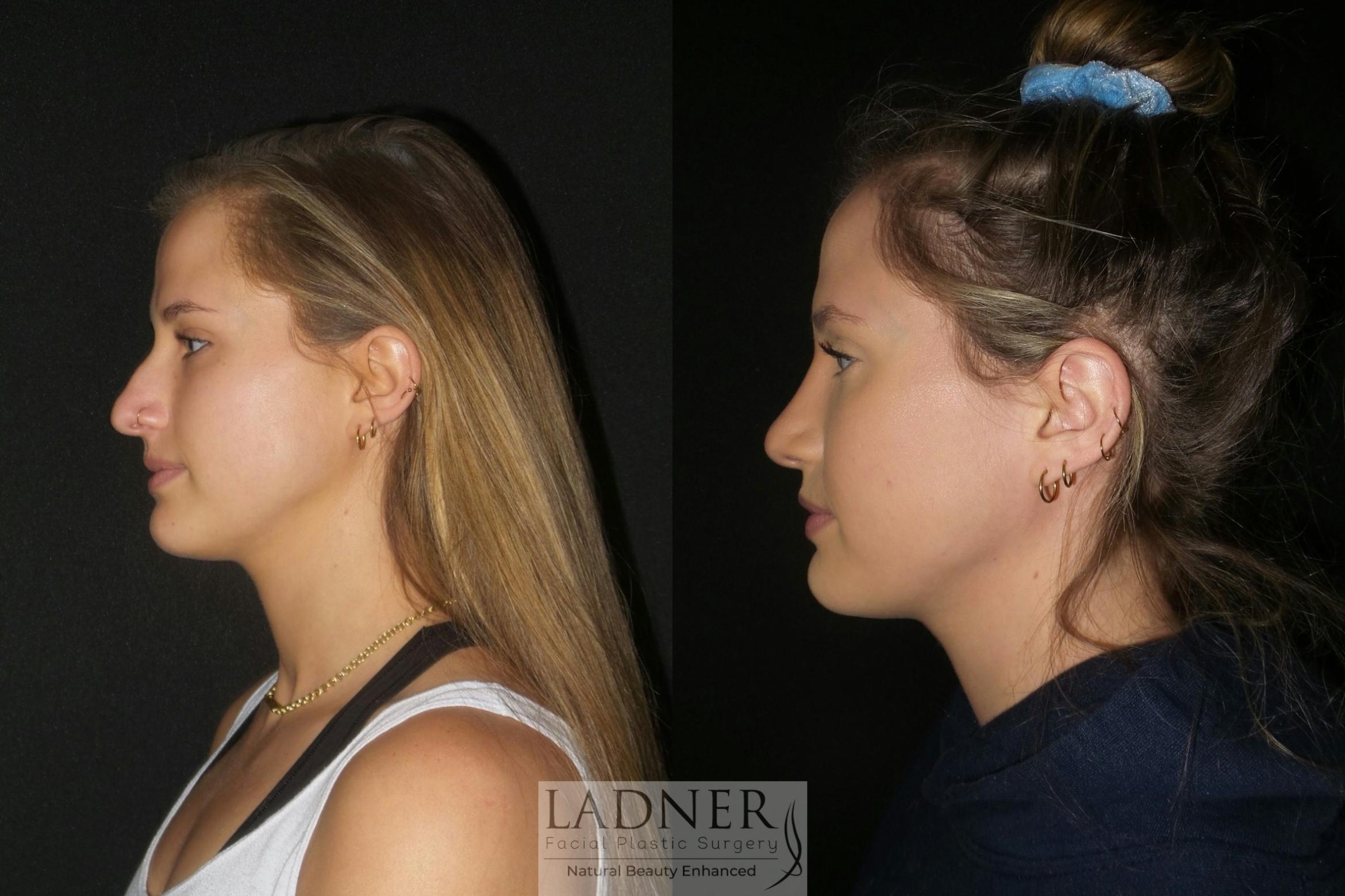 Rhinoplasty Case 80 Before & After Left Side | Denver, CO | Ladner Facial Plastic Surgery