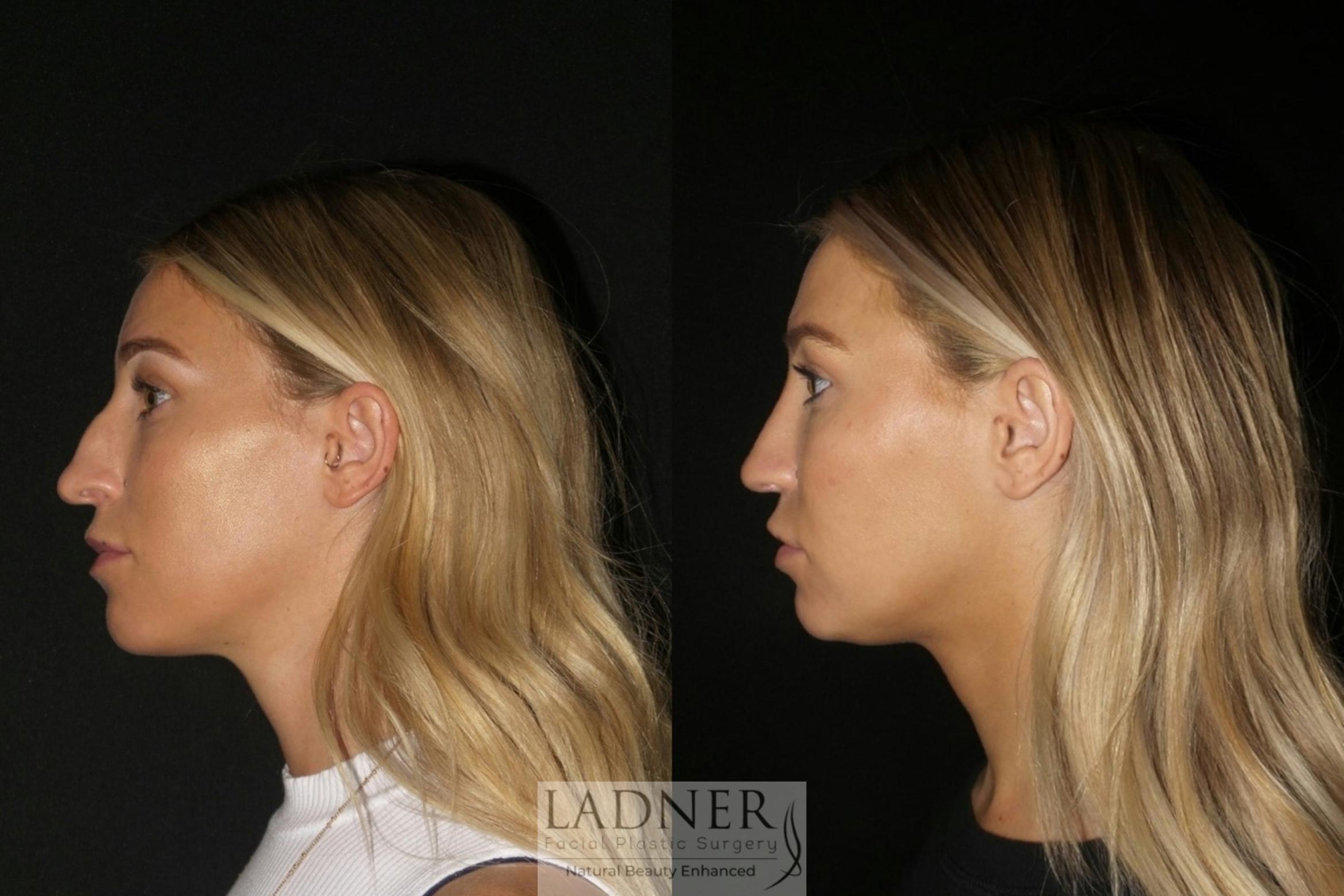 Rhinoplasty Case 81 Before & After Left Side | Denver, CO | Ladner Facial Plastic Surgery