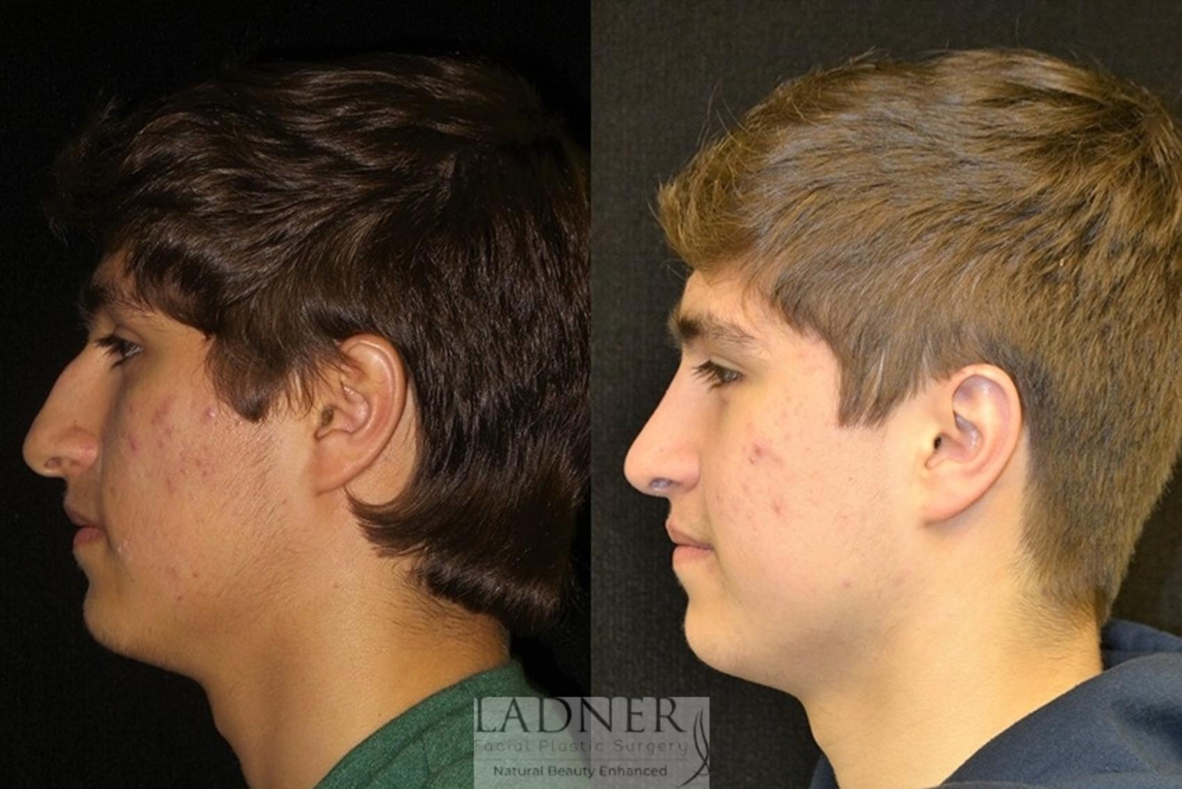 Rhinoplasty (Nose job) Case 10 Before & After Left Side | Denver, CO | Ladner Facial Plastic Surgery