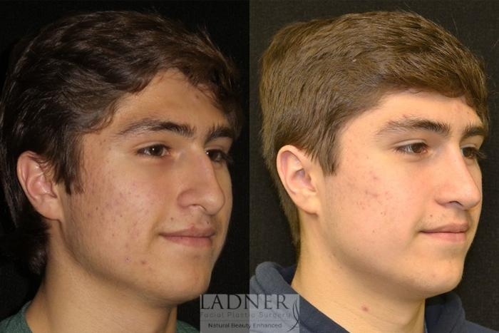 Rhinoplasty (Nose job) Case 10 Before & After Right Oblique | Denver, CO | Ladner Facial Plastic Surgery