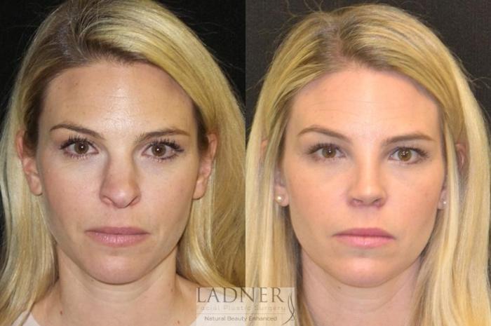 Rhinoplasty (Nose job) Case 11 Before & After Front | Denver, CO | Ladner Facial Plastic Surgery