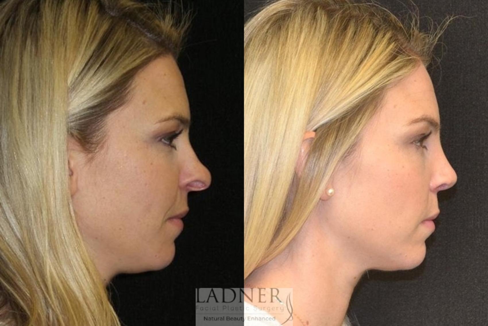 Rhinoplasty (Nose job) Case 11 Before & After Right Side | Denver, CO | Ladner Facial Plastic Surgery