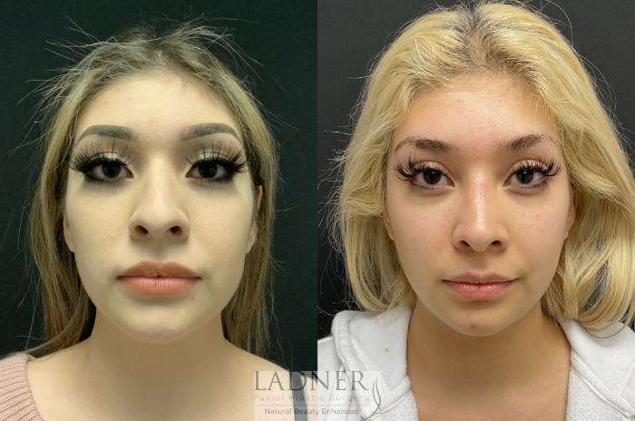 Rhinoplasty (Nose job) Case 124 Before & After Front | Denver, CO | Ladner Facial Plastic Surgery