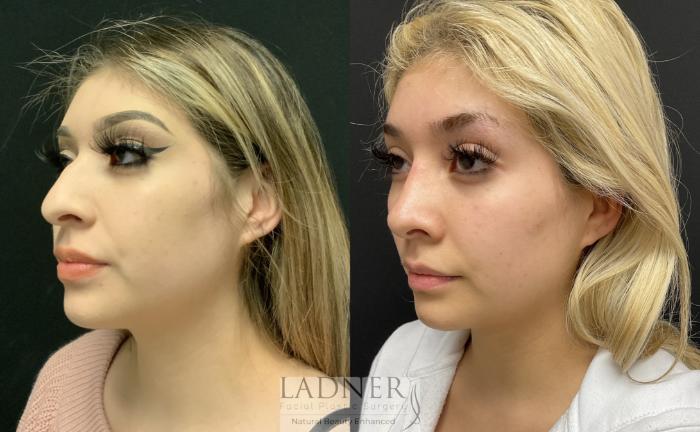 Rhinoplasty (Nose job) Case 124 Before & After Left Oblique | Denver, CO | Ladner Facial Plastic Surgery