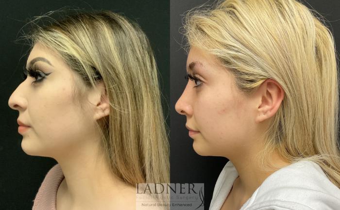 Rhinoplasty (Nose job) Case 124 Before & After Left Side | Denver, CO | Ladner Facial Plastic Surgery