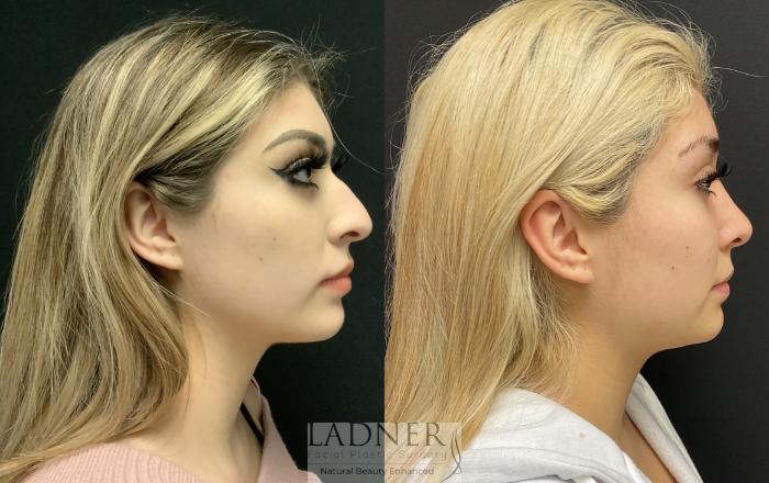 Rhinoplasty (Nose job) Case 124 Before & After Right Side | Denver, CO | Ladner Facial Plastic Surgery