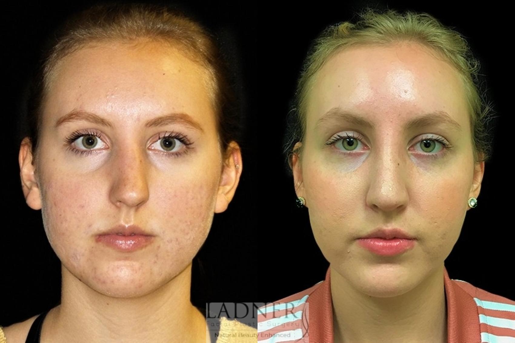 Rhinoplasty (Nose job) Case 13 Before & After Front | Denver, CO | Ladner Facial Plastic Surgery