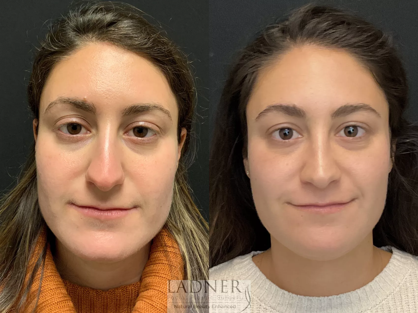 rhinoplasty-nose-job-135-front