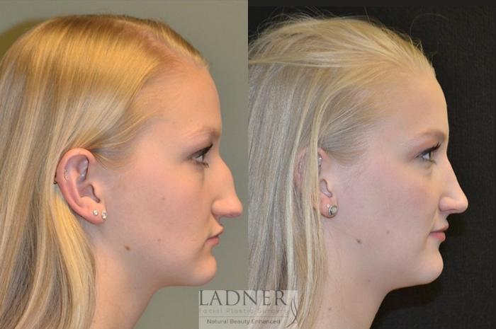 Rhinoplasty (Nose job) Case 14 Before & After Right Side | Denver, CO | Ladner Facial Plastic Surgery