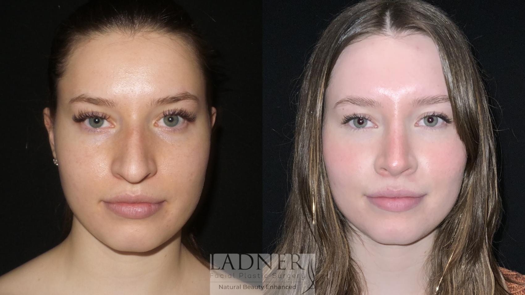 Rhinoplasty (Nose job) Case 146 Before & After Front | Denver, CO | Ladner Facial Plastic Surgery
