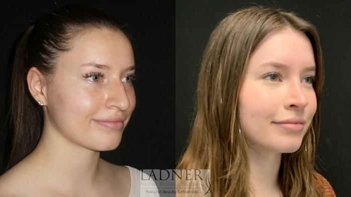 Rhinoplasty (Nose job) Case 146 Before & After Right Oblique | Denver, CO | Ladner Facial Plastic Surgery
