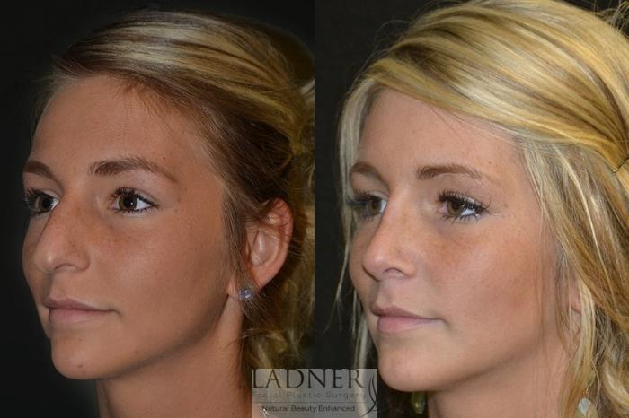 Rhinoplasty (Nose job) Case 15 Before & After Left Oblique | Denver, CO | Ladner Facial Plastic Surgery