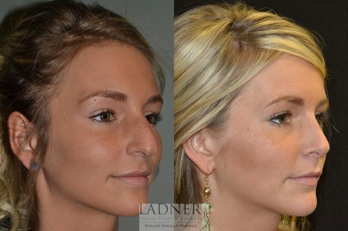 Rhinoplasty (Nose job) Case 15 Before & After Right Oblique | Denver, CO | Ladner Facial Plastic Surgery