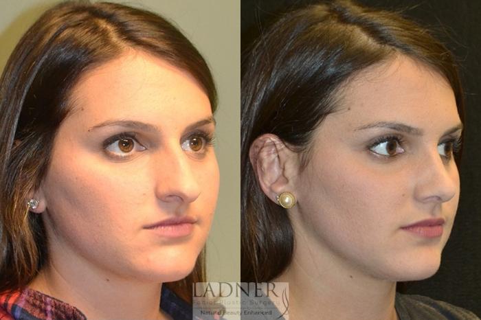 Rhinoplasty (Nose job) Case 16 Before & After Right Oblique | Denver, CO | Ladner Facial Plastic Surgery
