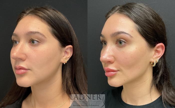 Rhinoplasty (Nose job) Case 168 Before & After Left Oblique | Denver, CO | Ladner Facial Plastic Surgery