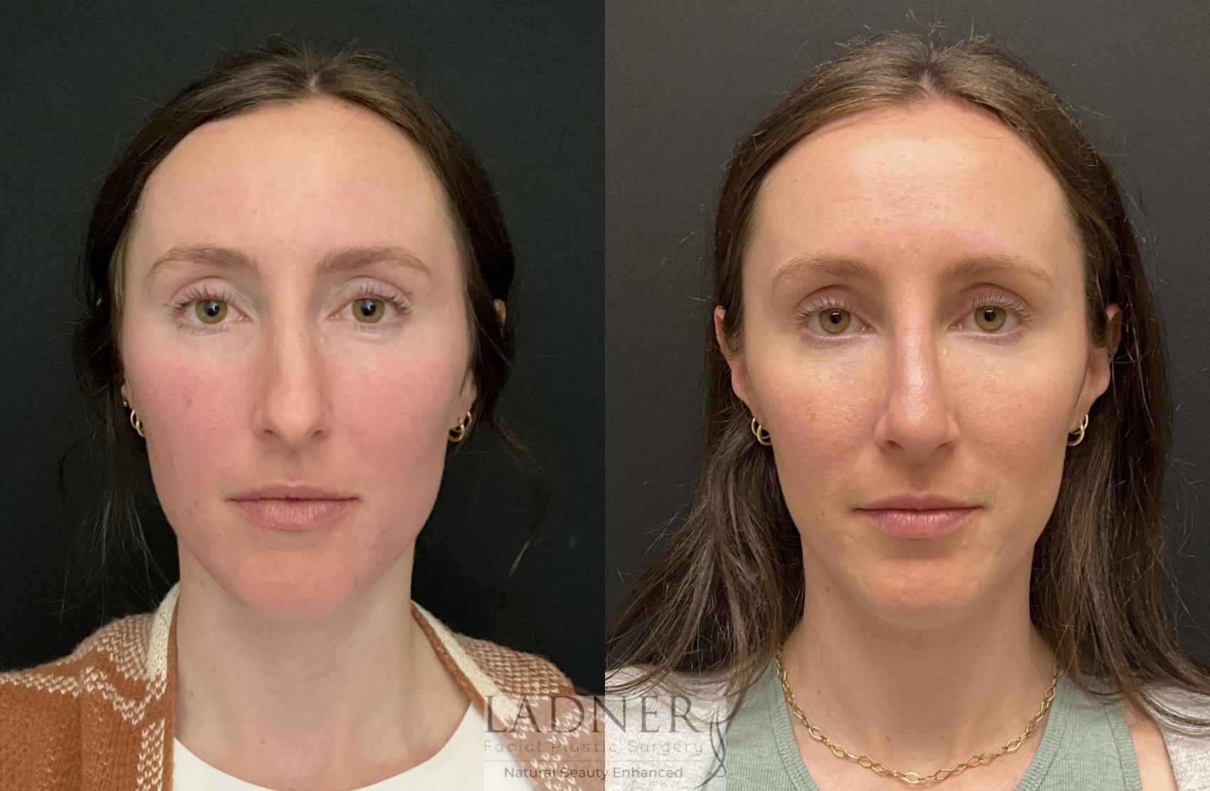 Rhinoplasty (Nose job) Case 169 Before & After Front | Denver, CO | Ladner Facial Plastic Surgery
