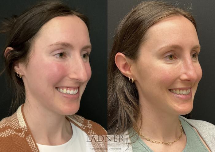 Rhinoplasty (Nose job) Case 169 Before & After Right Oblique | Denver, CO | Ladner Facial Plastic Surgery