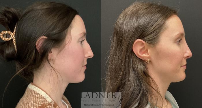 Rhinoplasty (Nose job) Case 169 Before & After Right Side | Denver, CO | Ladner Facial Plastic Surgery