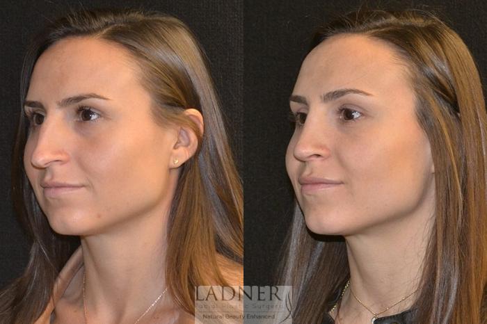 Rhinoplasty (Nose job) Case 17 Before & After Left Oblique | Denver, CO | Ladner Facial Plastic Surgery