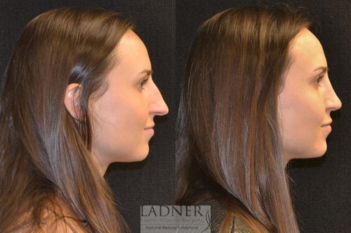 Rhinoplasty (Nose job) Case 17 Before & After Right Side | Denver, CO | Ladner Facial Plastic Surgery