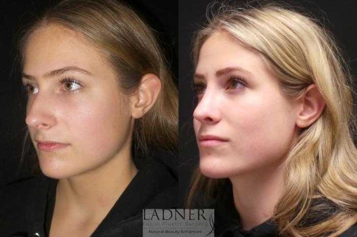 Rhinoplasty (Nose job) Case 174 Before & After Left Oblique | Denver, CO | Ladner Facial Plastic Surgery