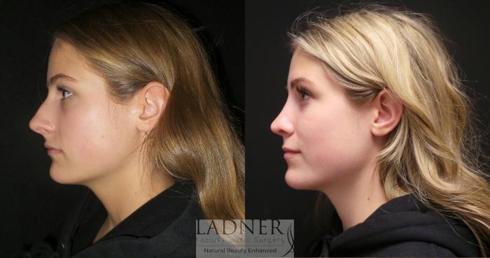 Rhinoplasty (Nose job) Case 174 Before & After Left Side | Denver, CO | Ladner Facial Plastic Surgery