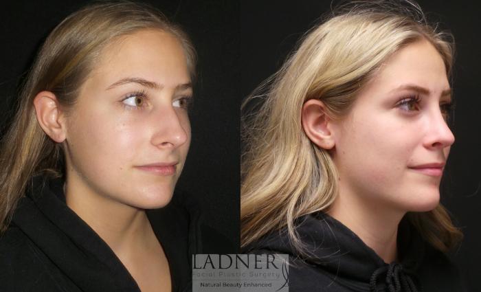 Rhinoplasty (Nose job) Case 174 Before & After Right Oblique | Denver, CO | Ladner Facial Plastic Surgery