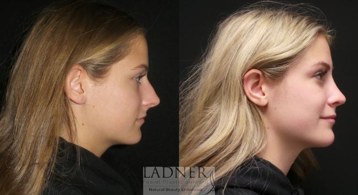 Rhinoplasty (Nose job) Case 174 Before & After Right Side | Denver, CO | Ladner Facial Plastic Surgery