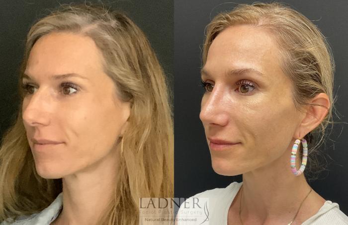 Rhinoplasty (Nose job) Case 177 Before & After Left Oblique | Denver, CO | Ladner Facial Plastic Surgery
