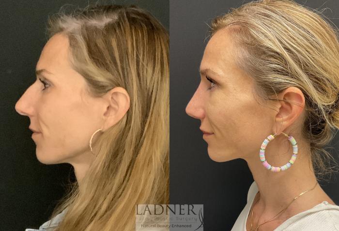 Rhinoplasty (Nose job) Case 177 Before & After Left Side | Denver, CO | Ladner Facial Plastic Surgery