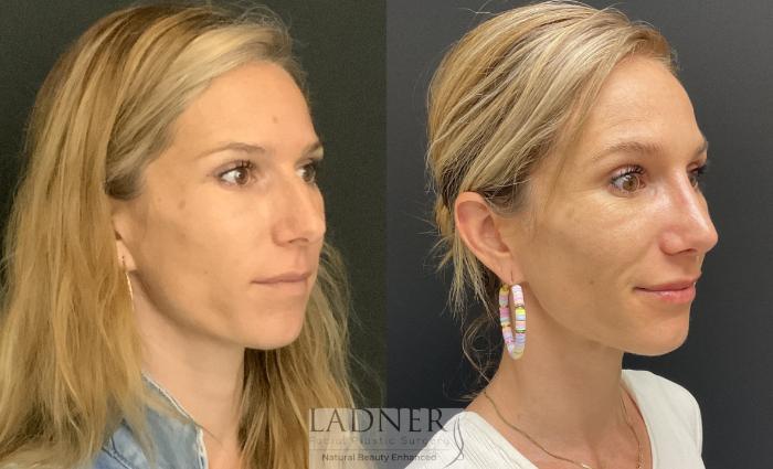 Rhinoplasty (Nose job) Case 177 Before & After Right Oblique | Denver, CO | Ladner Facial Plastic Surgery