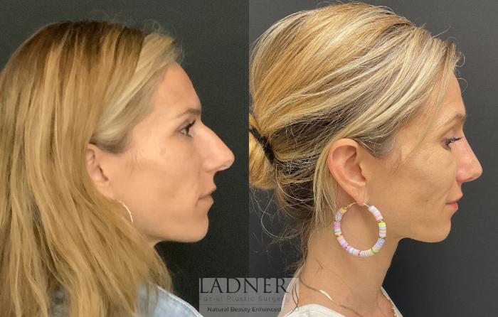 Rhinoplasty (Nose job) Case 177 Before & After Right Side | Denver, CO | Ladner Facial Plastic Surgery