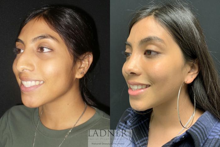 Rhinoplasty (Nose job) Case 179 Before & After Left Oblique | Denver, CO | Ladner Facial Plastic Surgery
