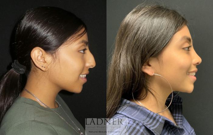Rhinoplasty (Nose job) Case 179 Before & After Right Side | Denver, CO | Ladner Facial Plastic Surgery