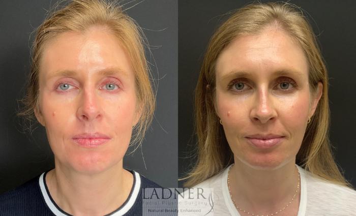 Rhinoplasty (Nose job) Case 181 Before & After Front | Denver, CO | Ladner Facial Plastic Surgery